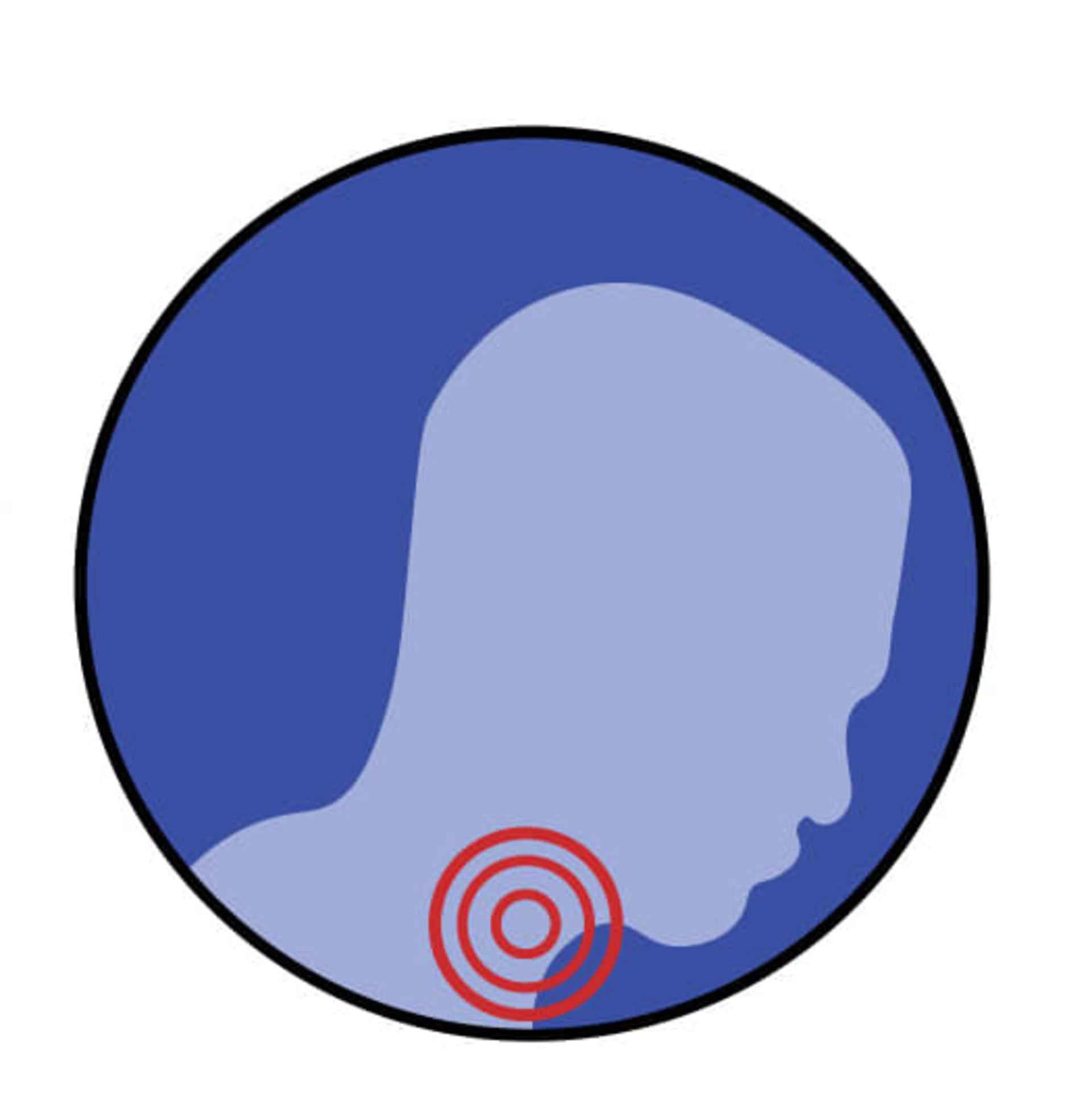Acid Reflux pain location graphic image